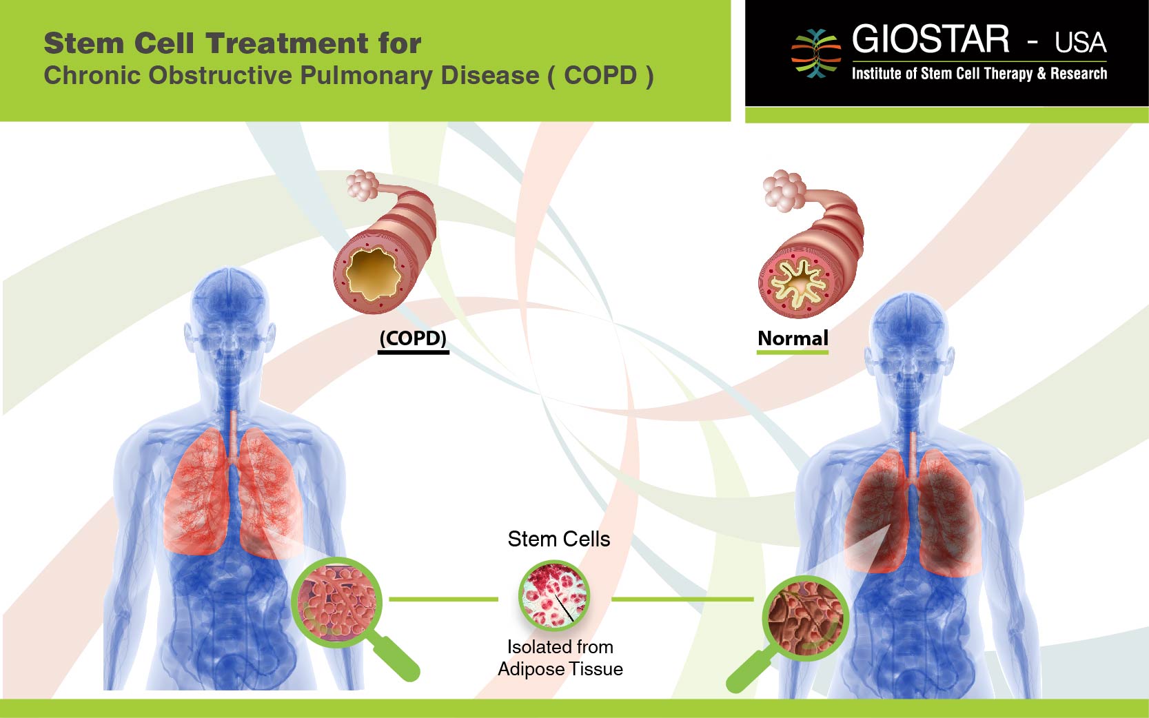 Lung Disease Treatment India, Stem Cell Therapy for COPD