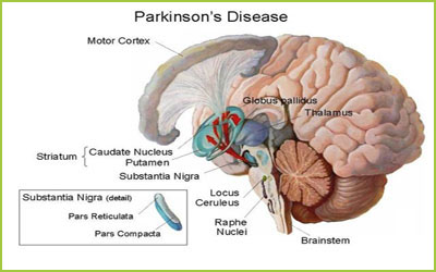 Parkinson's Treatment