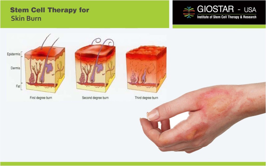 Skin Burn Treatment Giostar