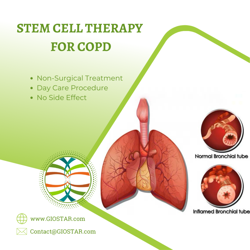 Stem Cell Therapy for COPD
