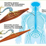 ALS Treatment – Giostar