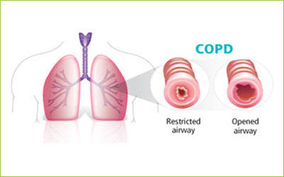 COPD Stem Cell Therapy Giostar