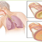 COPD Giostar Stem Cell Therapy