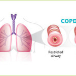 COPD Treatment – Giostar