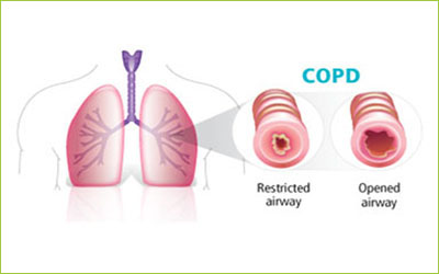 COPD Treatment - Giostar