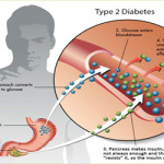 Diabetes Type II Treatment – Giostar
