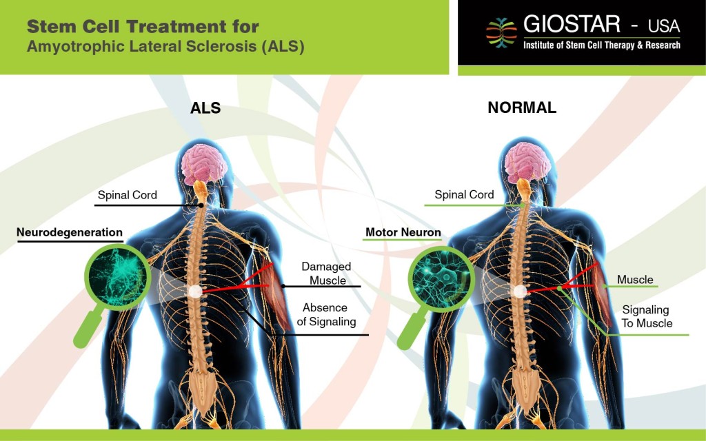 Stem Cell Treatment for ALS