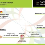 Stem Cell Treatment for Critical Limb Ischemia