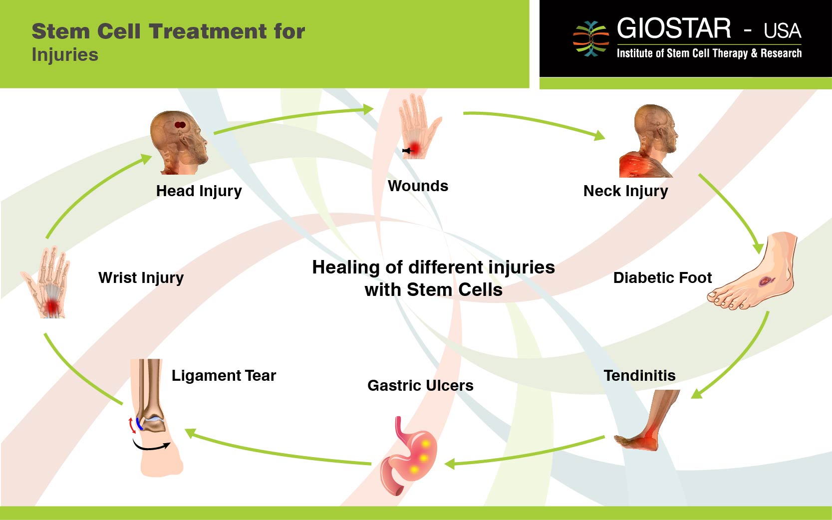 Stem Cell Treatment for Injuries