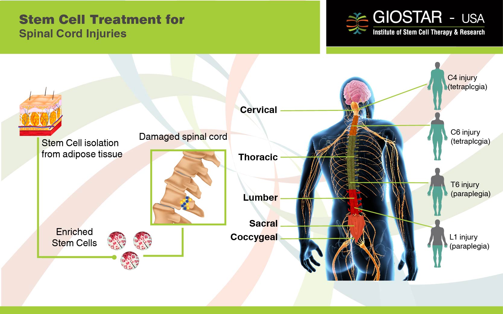 Stem Cell Therapy For Spinal Cord Injury