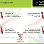 Stem Cell Treatment for Stroke