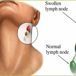Lymphoma Treatment From Stem Cells