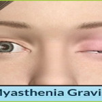 Myasthenia Gravis Treatment