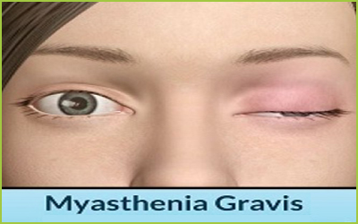Myasthenia Gravis Treatment