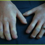 SCLERODERMA TREATMENT – GIOSTAR