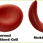 SICKLE CELL ANEMIA TREATMENT