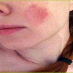 Skin Burn Treatment Giostar