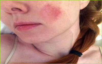 Skin Burn Treatment Giostar