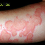 Vasculitis Treatment – GIOSTAR