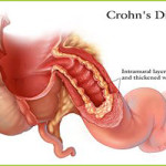 Crohn Disease Treatment – GIOSTAR