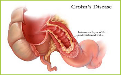 Crohn Disease Treatment - GIOSTAR