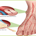 Diabetic Neuropathy Treatment