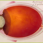Retinal Treatment – GIOSTAR