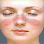 Lupus Treatment from Stem Cells