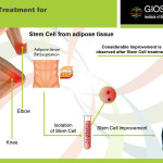 Orthopaedics-Treatment-Giostar