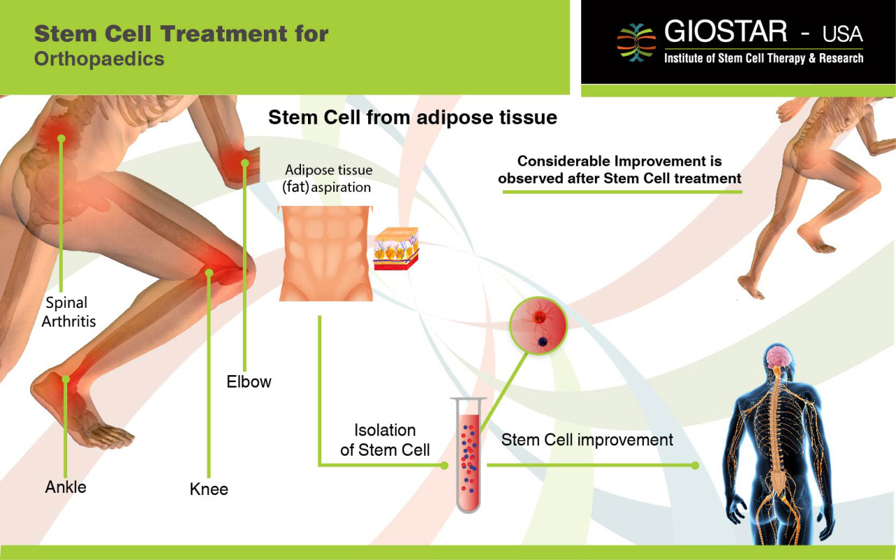 Stem Cell Treatment for Osteoarthritis